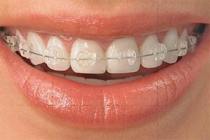 Fixed ceramic braces