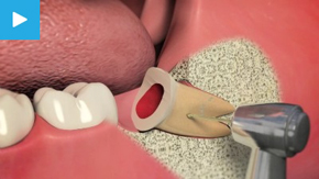 Extractions / Oral Surgery