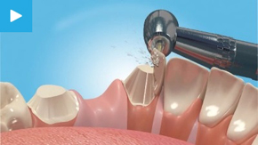 Dental Bridges